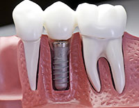 Dentist Avondale AZ Dental Implants