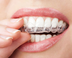 invisalign avondale